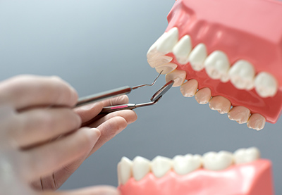 Komposit-Zahnfüllungen Antalya