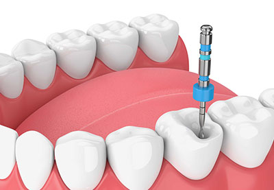 Behandlung infizierter Wurzelkanäle in Antalya