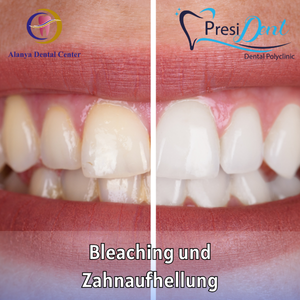 bleaching professionell