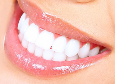 bonding - bester zahnarzt in alanya